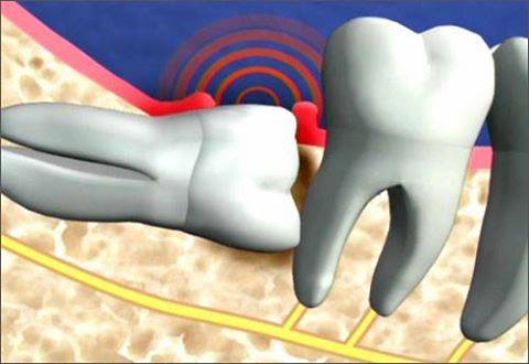 Mọc răng khôn gây ra những tác hại gì?